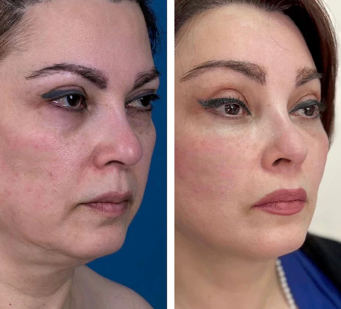 بهبود بافت پوست / افزایش استحکام پوست / سفت کردن پوست و رفع چین و چروک / افزایش آبرسانی پوست و جلوگیری از ایجاد چین و چروک